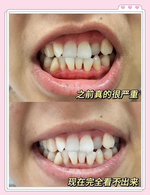 矫正牙齿过程中得了牙周炎，是什么原因导致的？该如何正确处理？-图3