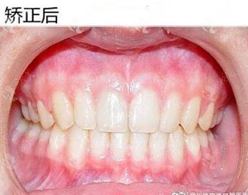 格莱美口腔牙齿矫正效果如何？靠谱吗？-图1