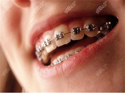 格莱美口腔牙齿矫正效果如何？靠谱吗？-图2