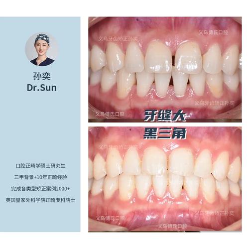 矫正牙齿会让牙齿变黑吗？-图1