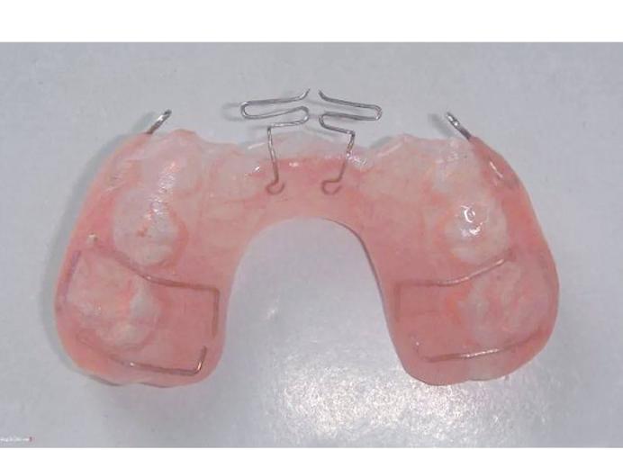 活动矫正器矫正牙齿效果如何？适合哪些牙齿问题？佩戴需要注意什么？-图3