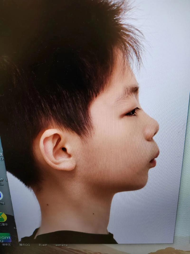 矫正牙齿后牙齿酸痛正常吗？原因是什么，怎么缓解？-图3