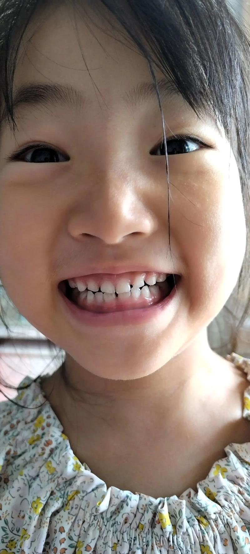 矫正一个月牙齿效果如何?变化是否正常?-图1 矫正一个月牙齿效果如何?变化是否正常?-图1