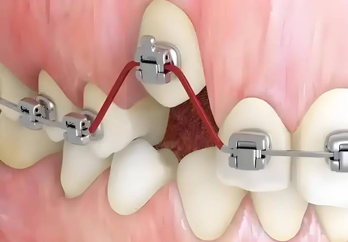 牙齿能矫正第二次吗-图3 牙齿能矫正第二次吗-图3