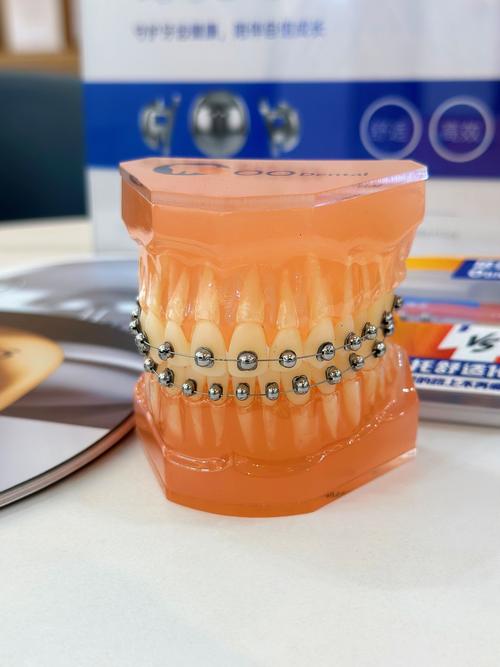 3D打印牙齿矫正器相比传统有何矫正优势？-图3