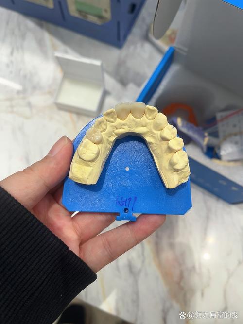 3D打印牙齿矫正器相比传统有何矫正优势？-图2