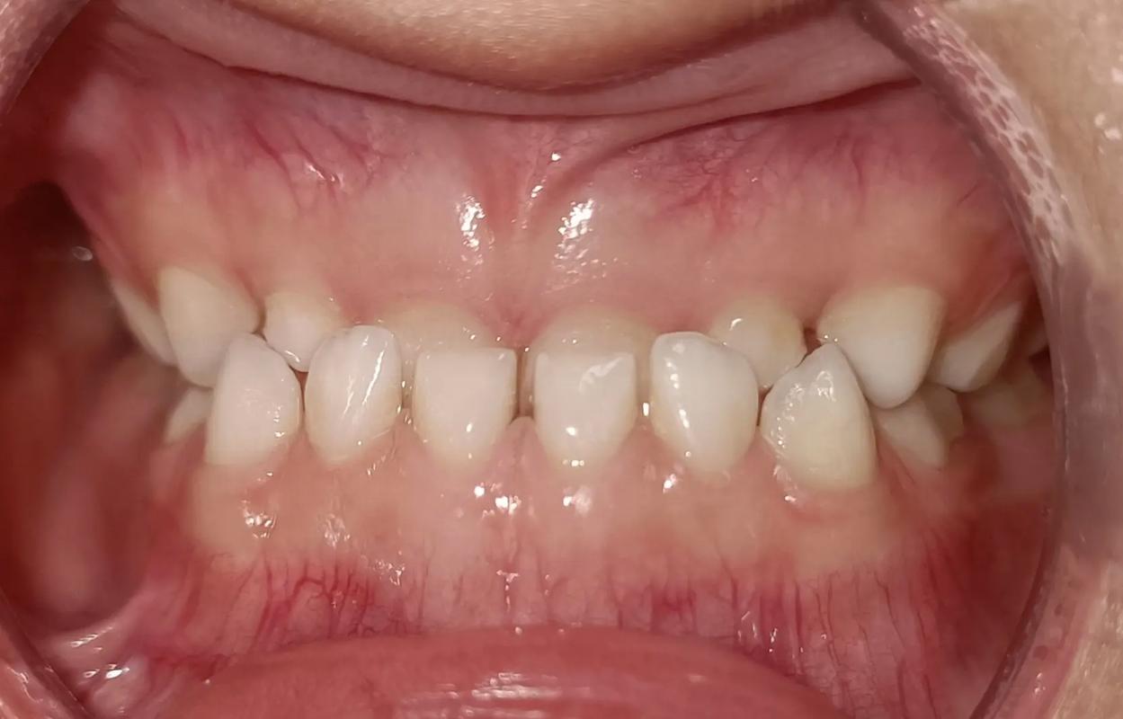 矫正牙齿只整上排？效果和美观能兼顾吗？-图1