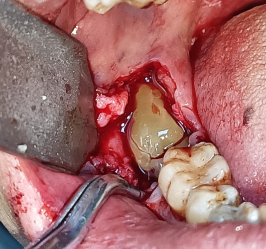 牙齿矫正下牙拔一颗-图3