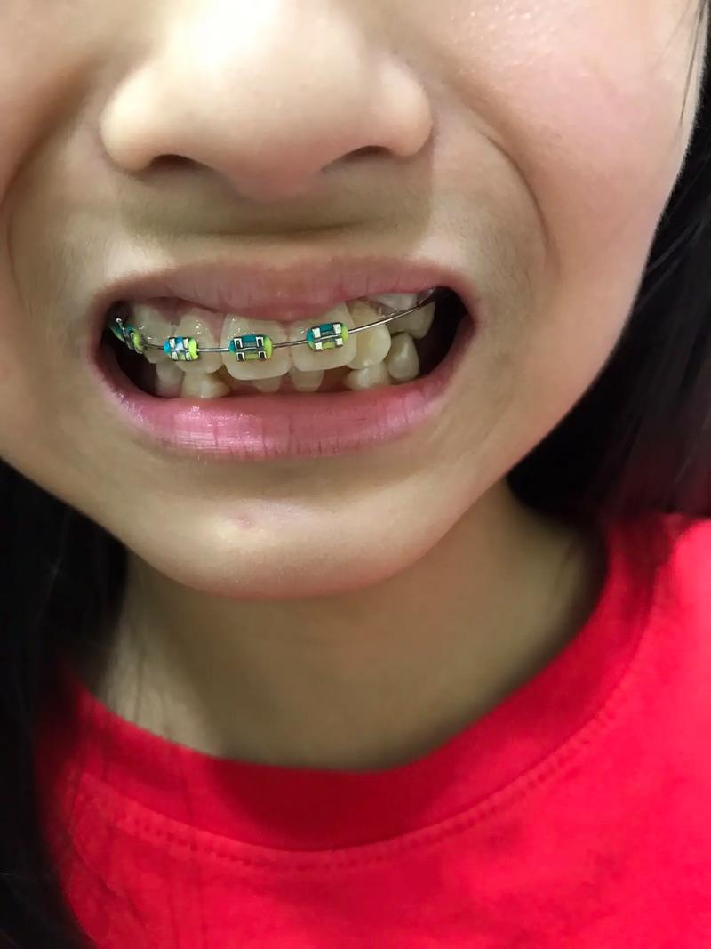 牙齿矫正只拔一颗牙？效果会受影响吗？-图3