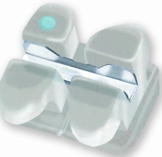 3m牙齿矫正器图片能看清哪些佩戴效果？-图2