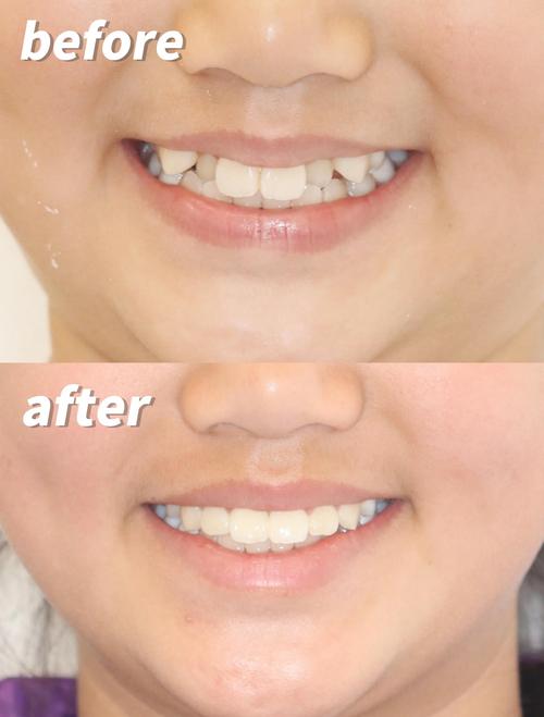 矫正牙齿后变瘦？是牙齿作用还是习惯改变？-图1