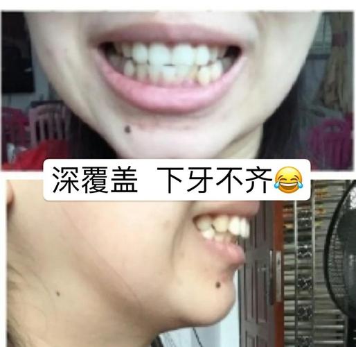 牙齿矫正后嘴型会改变吗？-图1