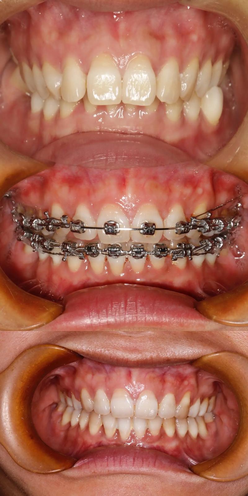 矫正牙齿带牙环的图，牙环有何作用？-图3