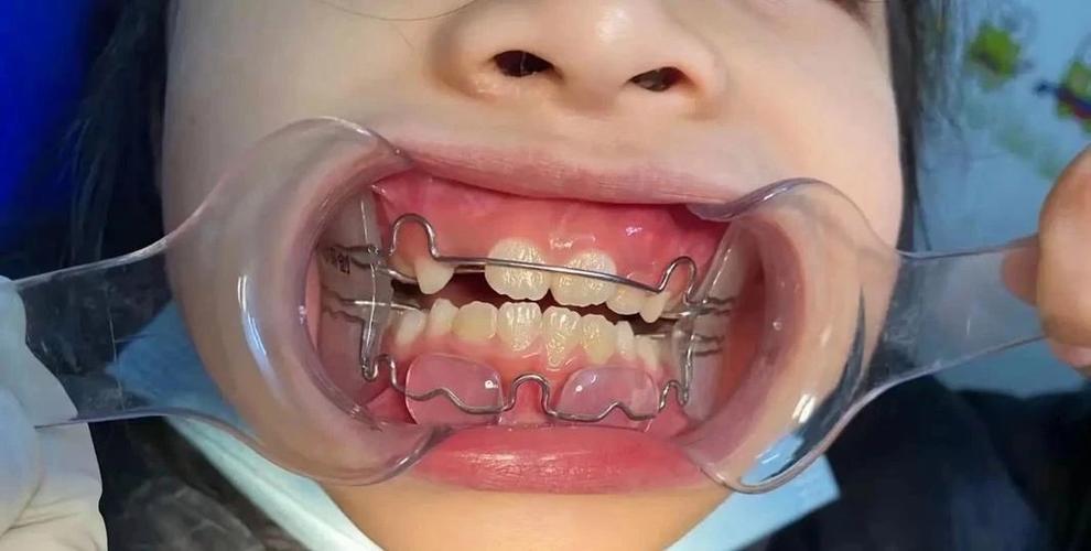 儿童牙齿反颌矫正器-图1