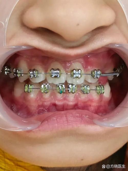 矫正牙齿真的会很疼吗？-图3