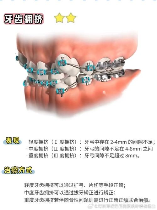 天包地牙齿矫正有哪些常用方法？-图1