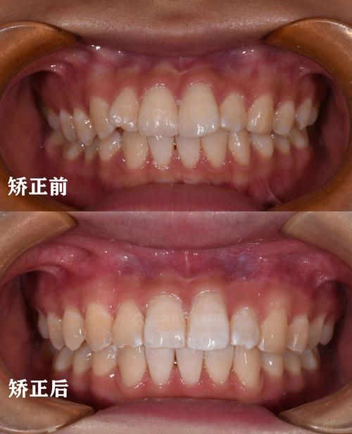 矫正完的牙齿，为何会悄悄反弹回原状？-图1