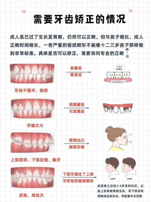 牙齿矫正一般需要多长时间完成？-图3