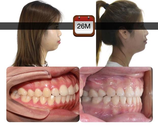 十八岁矫正牙齿，年龄会影响矫正效果吗？-图3