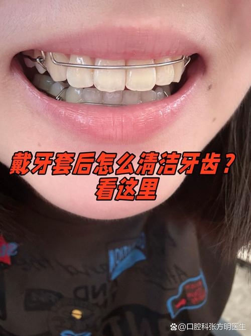 矫正牙齿前，洗牙是必须的吗？不洗会影响矫正效果吗？-图2