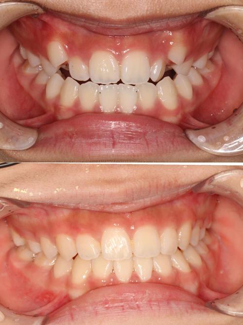 北大校医院矫正牙齿-图3