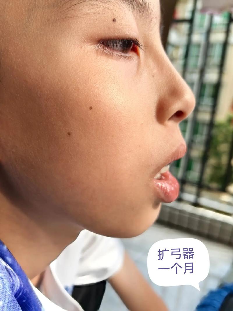 八岁矫正牙齿，这个年龄开始矫正到底合不合适？-图3