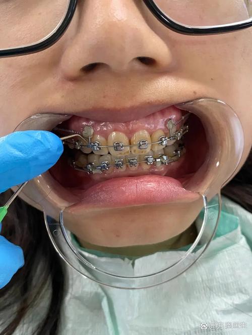 牙齿矫正戴牙套会痛吗？-图1