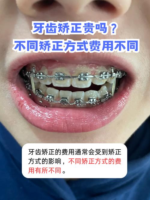 虎门牙齿矫正费用多少？价格受哪些因素影响？-图3