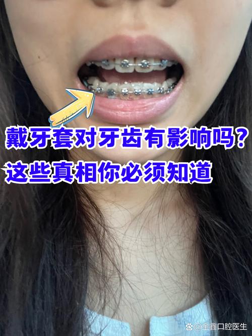 牙齿矫正器佩戴时会掉下来吗？-图1