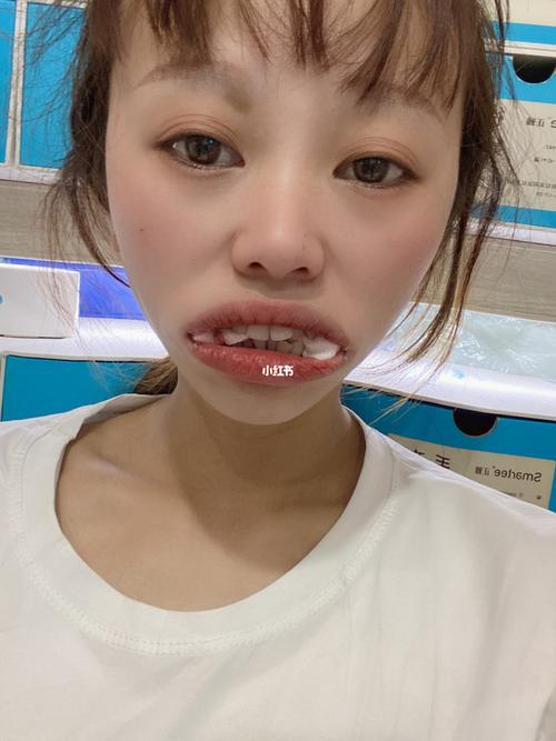 牙齿矫正拔一颗门牙，真的有必要吗？-图1