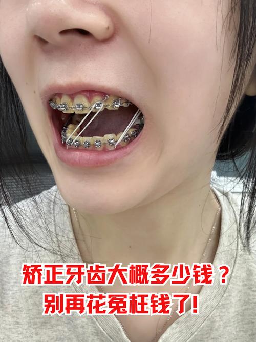 德阳矫正牙齿大概需要多少钱？费用情况如何呢？-图2