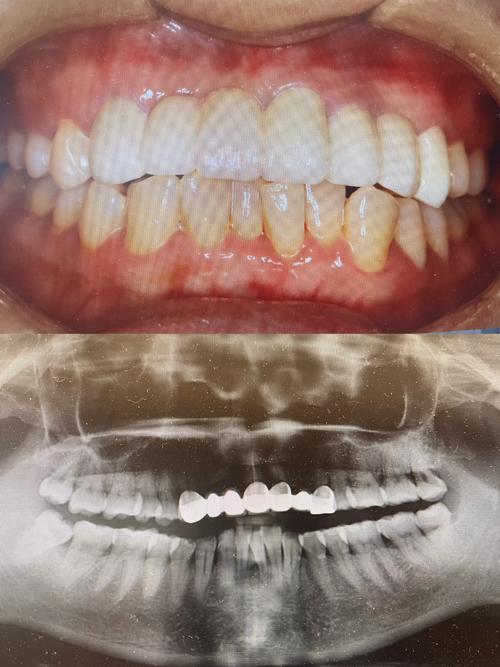 上海牙齿美容冠矫正效果如何？价格与适合人群是怎样的？-图1