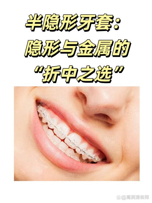 牙齿矫正后透明牙套，效果护理佩戴要注意啥？-图3