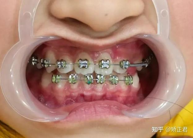 活动翼牙齿矫正效果如何？亲身经历求解答-图1