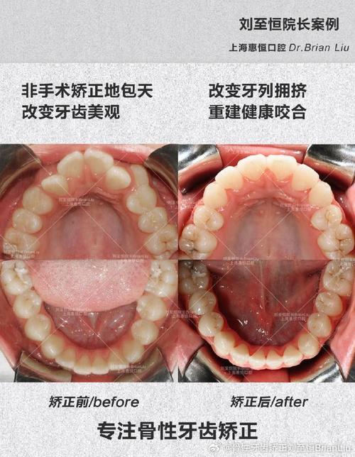 上海牙齿矫正哪家好？如何挑选靠谱机构？-图2