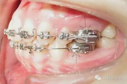 牙齿矫正全过程图片有哪些关键步骤？-图3