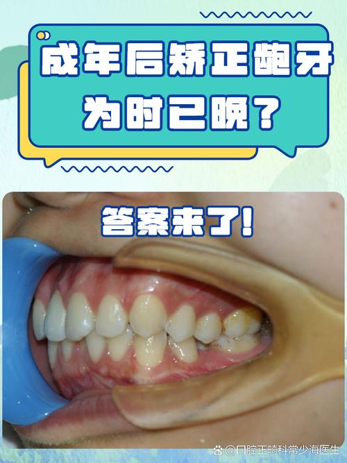 牙齿矫正反弹几率真的很大吗？-图3