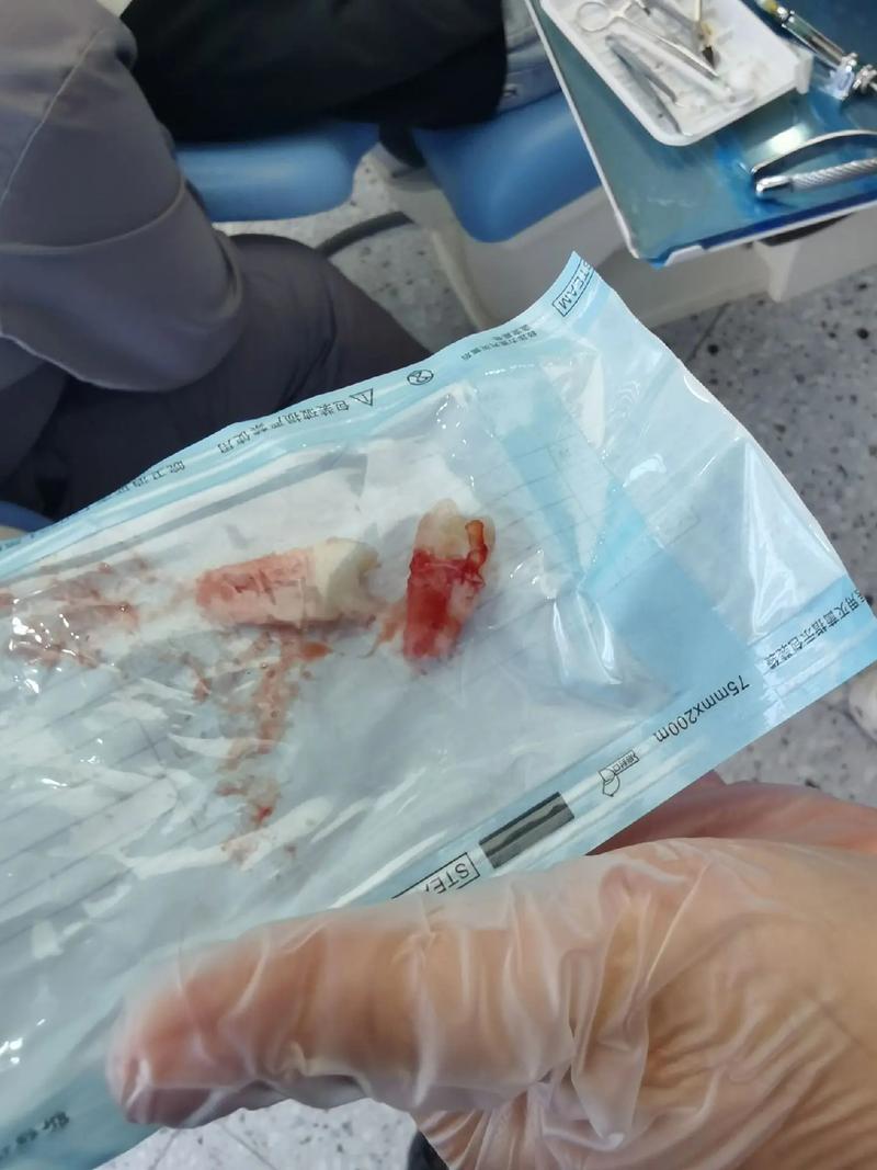 牙齿矫正拔牙到底有多痛？过程真的会很遭罪吗？-图2