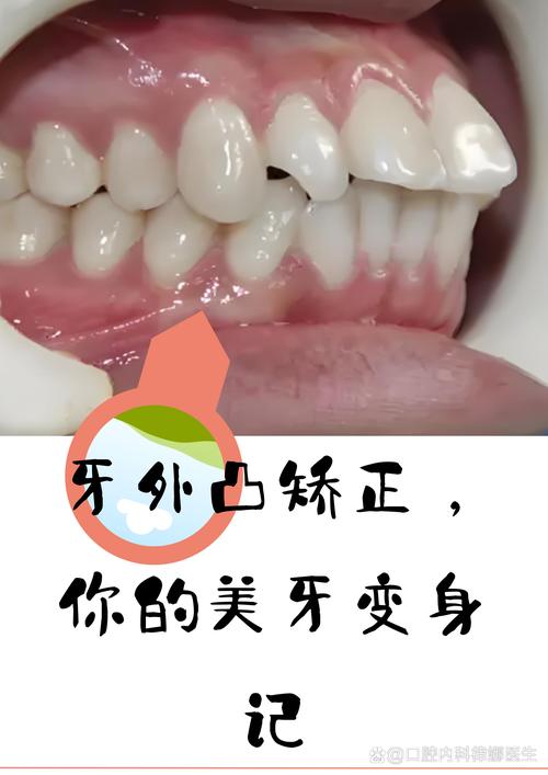 美牙牙齿矫正哪种好-图2