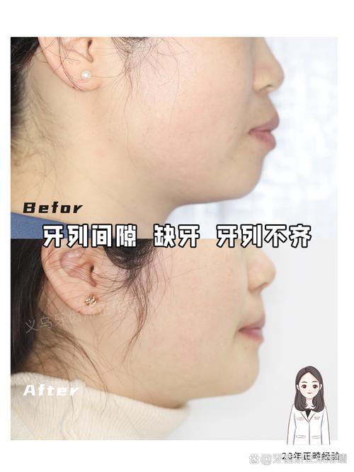 牙齿矫正真的会导致口齿不清吗？-图1