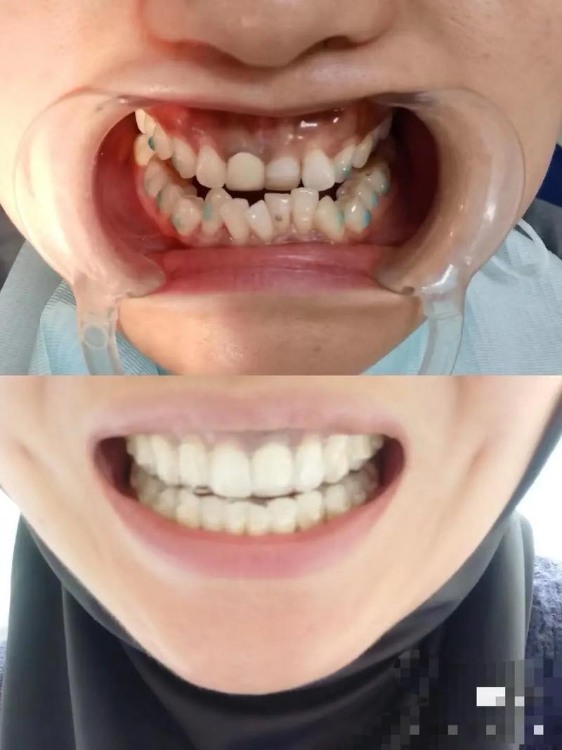 矫正牙齿后门牙前突-图3