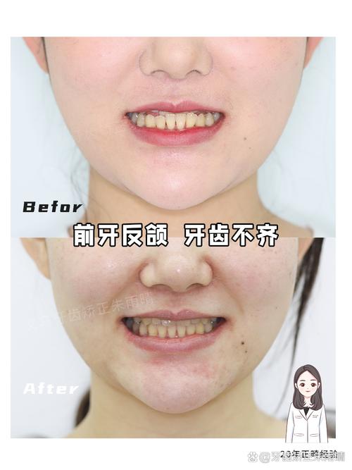 牙齿矫正不对称拔牙-图2