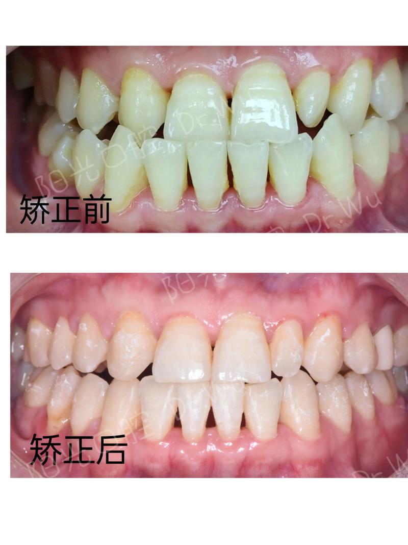 北京顺义区牙齿矫正，如何选择靠谱机构与效果保障？-图2