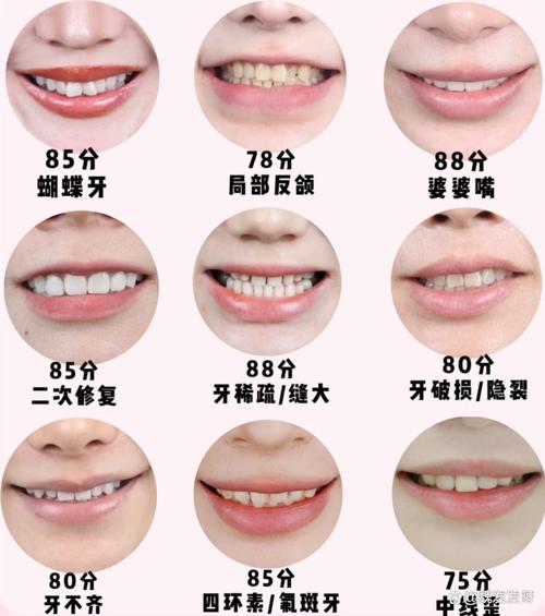 龅牙牙齿矫正要多久-图1