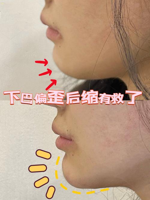 矫正牙齿后下巴歪了-图1