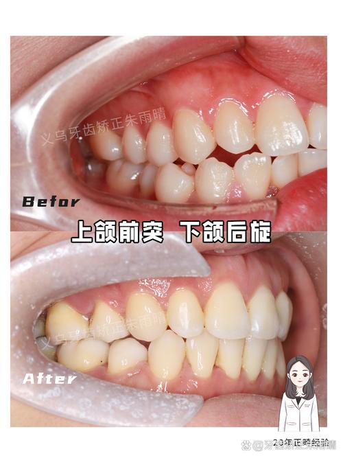 矫正牙齿后下巴歪了-图2