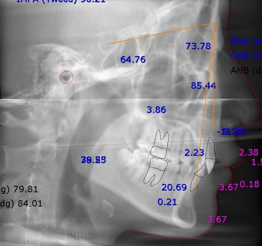 牙齿矫正头颅侧位片有何关键作用？-图3