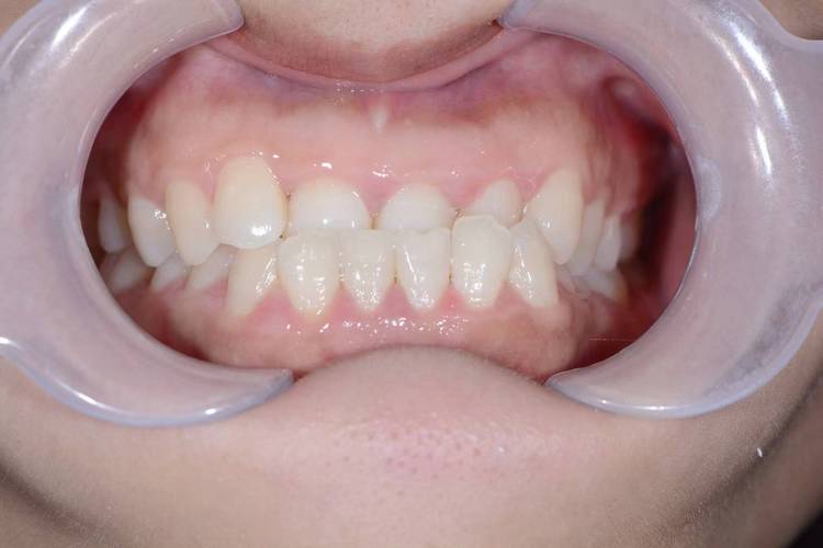 地包天牙齿矫正视频-图3