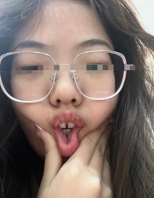 20岁矫正牙齿晚吗？成年后矫正还来得及吗？-图2