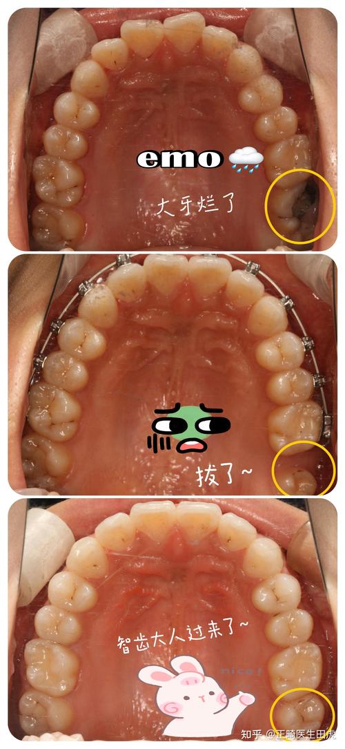 矫正期间拔智齿，真的有必要吗？-图1